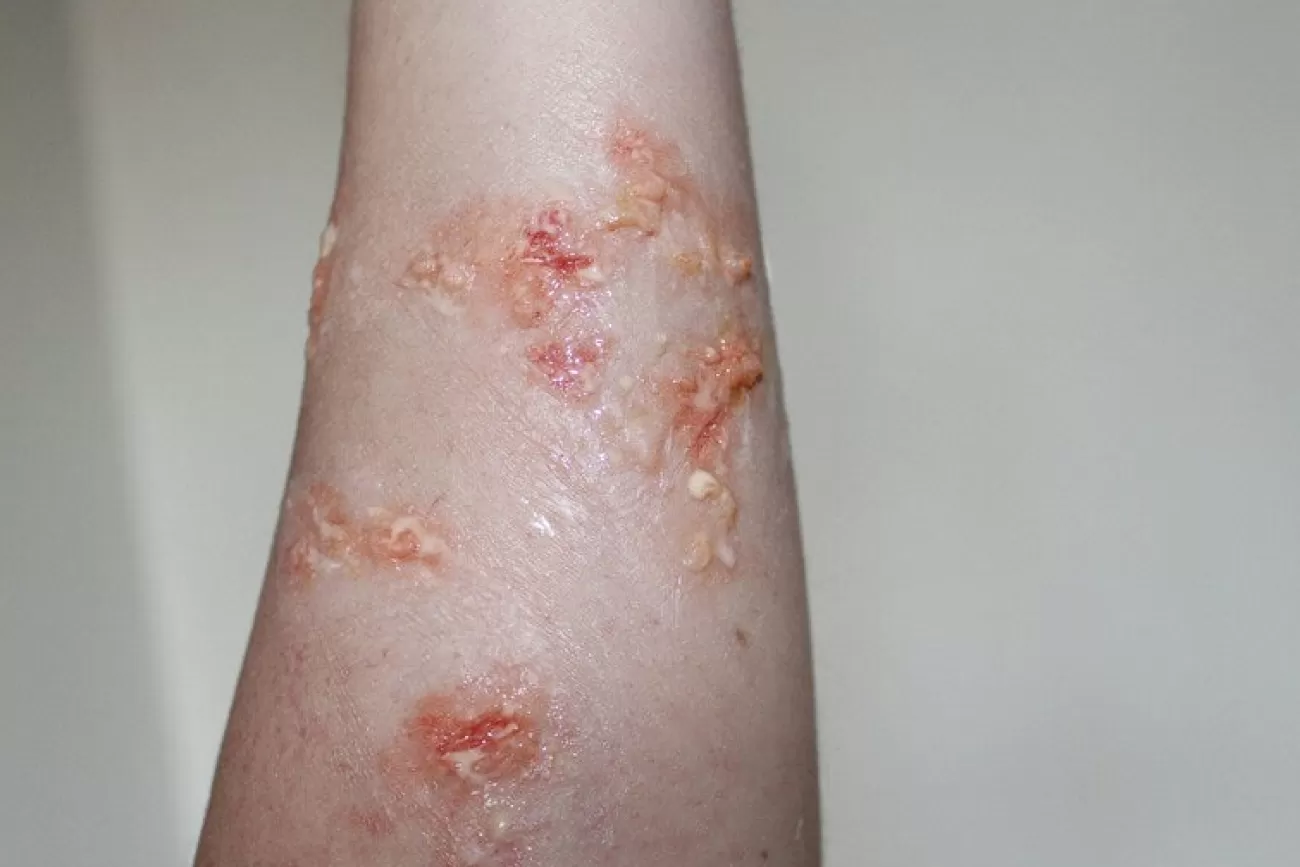ForensicFX Studios Infected Blisters / Boils Prosthetic> Halloween Accessories