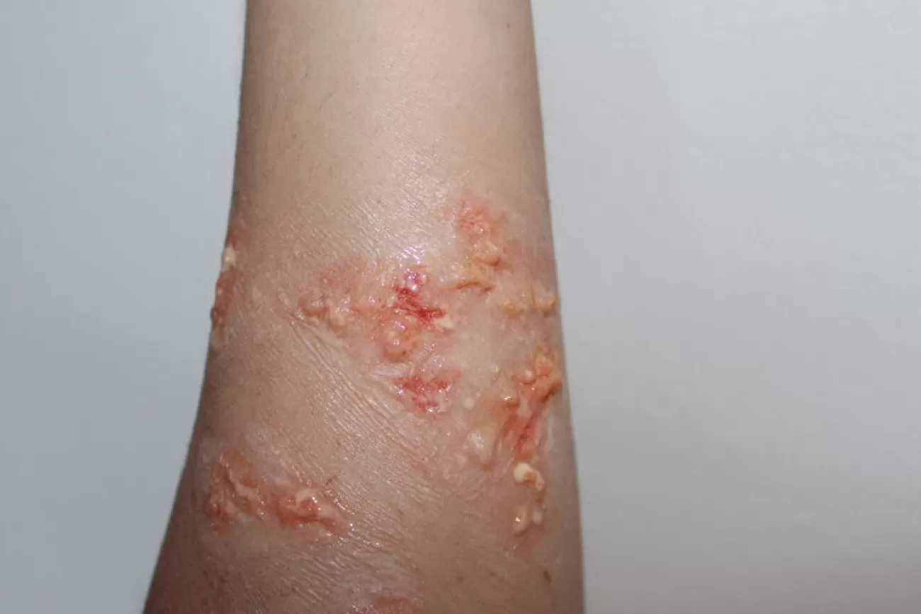 ForensicFX Studios Infected Blisters / Boils Prosthetic> Halloween Accessories