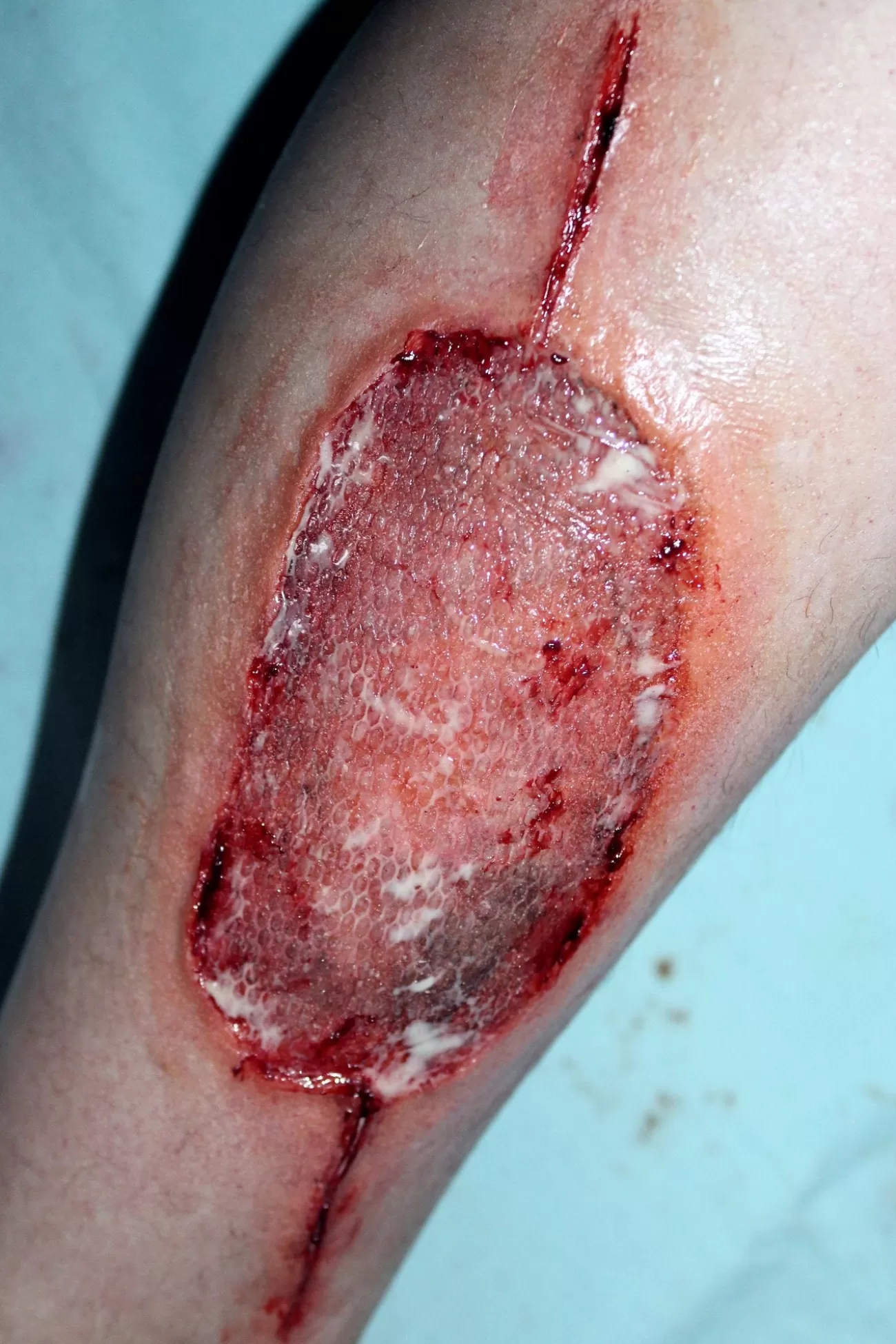 ForensicFX Studios Infected Medical Skin Graft Prosthetic> Halloween Accessories