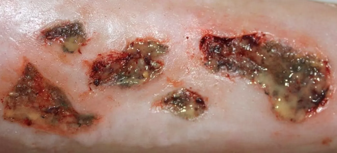 ForensicFX Studios Infected Wound / Burn Prosthetic> Halloween Accessories