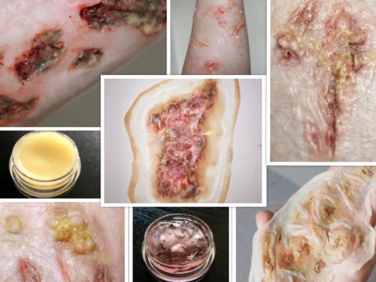 ForensicFX Studios Infected/Burn Wound Prosthetics Bundle> Halloween Accessories