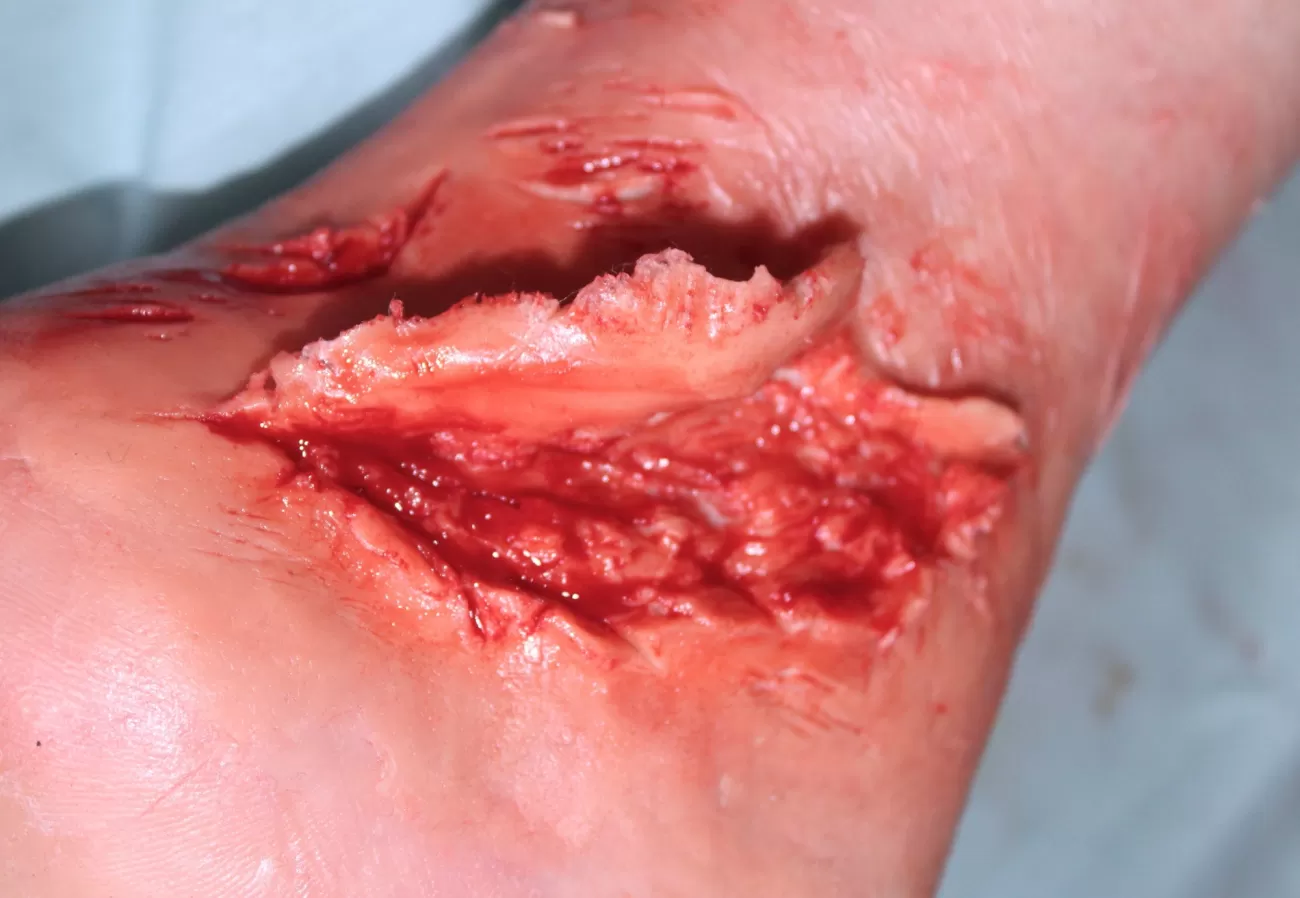 ForensicFX Studios Skin Peeling Back Wound Prosthetic> Halloween Accessories